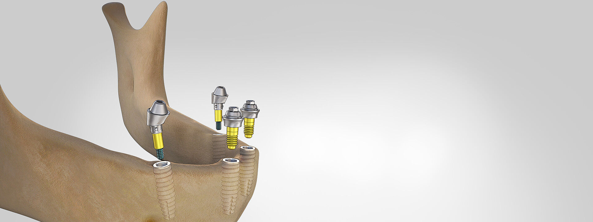 The Multi-unit system for restoring edentulous jaws