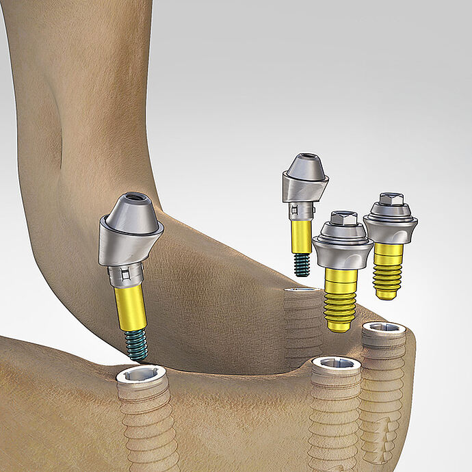 The Multi-unit System: Biohorizons Camlog Education Course with Dr. Gollner Schematic jaw with four Camlog implants and multi-unit restorations