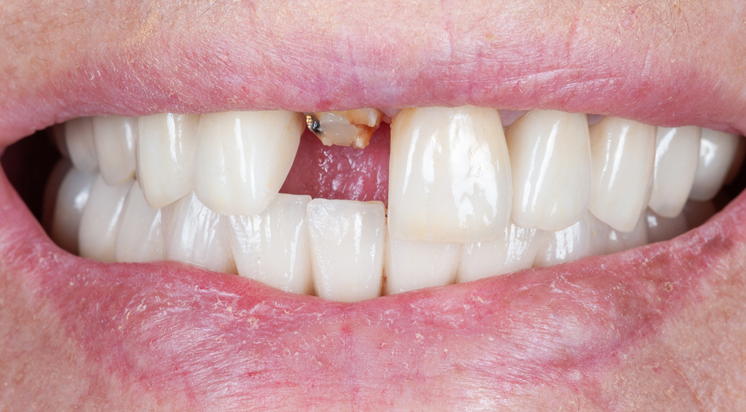 Pre-operative anterior view: missing front tooth