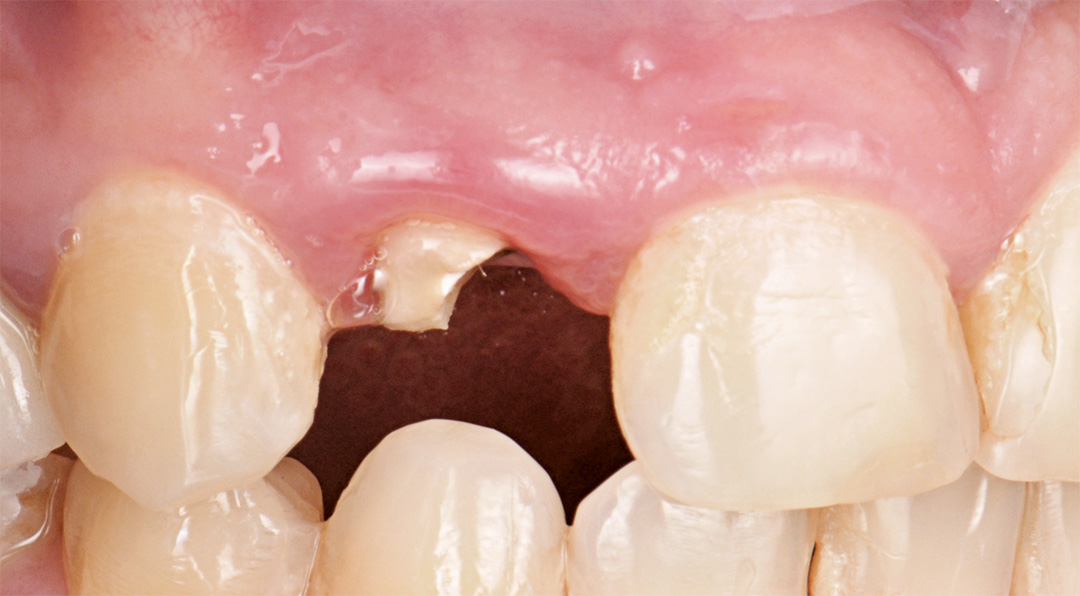Initial presentation showing the fractured tooth